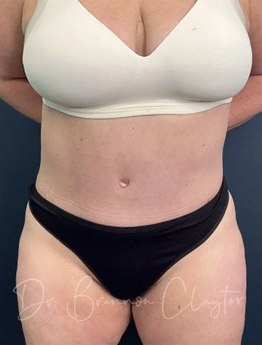 Tummy Tuck (Abdominoplasty) - Philadelphia, PA - Claytor Noone