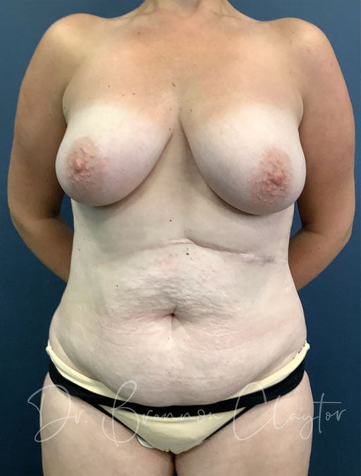 Drainless Tummy Tuck & Breast Lift