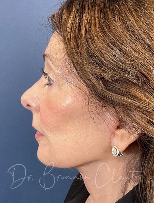 Patient of Dr. Claytor's before a deep plane facelift