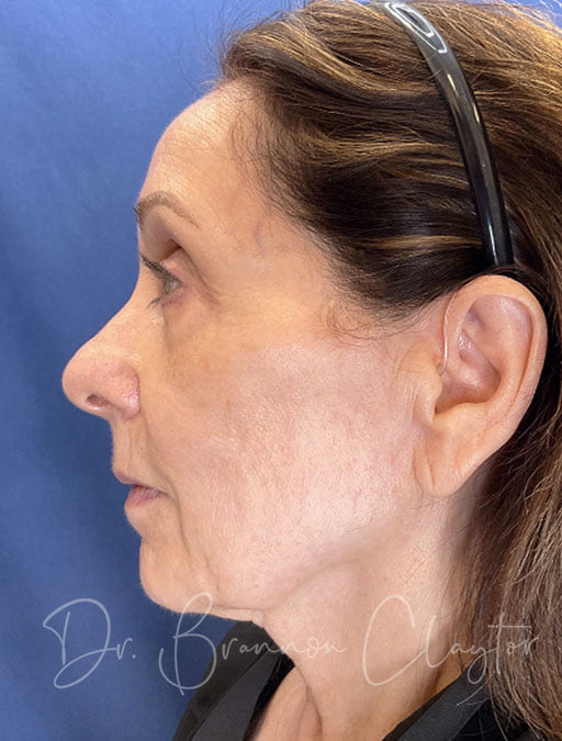 Patient of Dr. Claytor's before a deep plane facelift