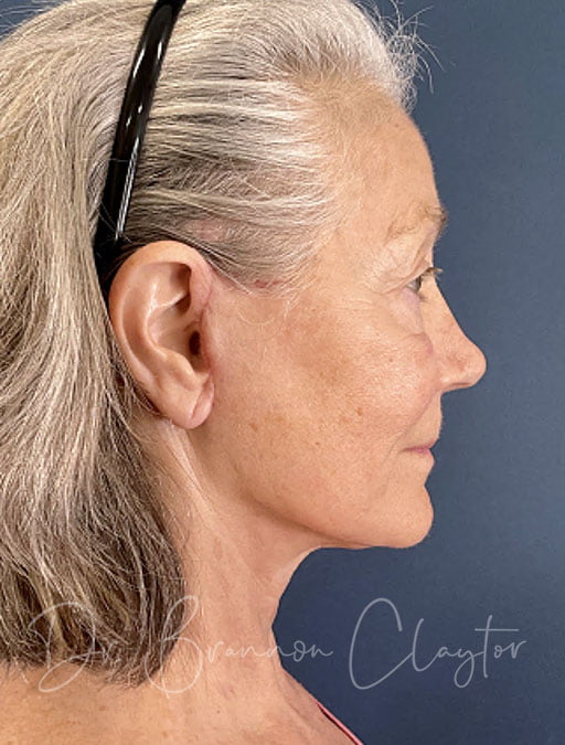 Deep plane facelift post-op photo