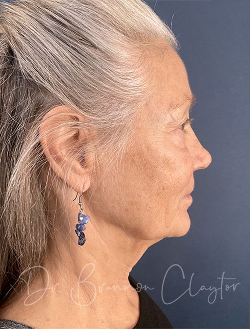 Deep plane facelift pre-op photo