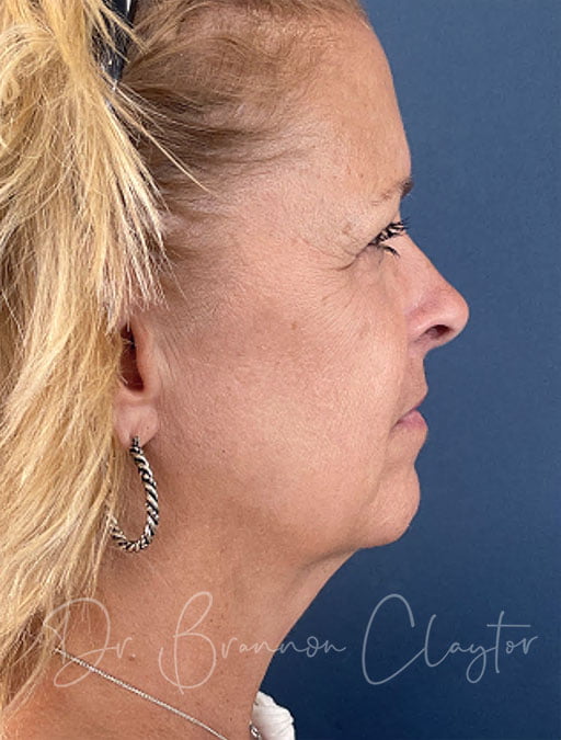 Facelift