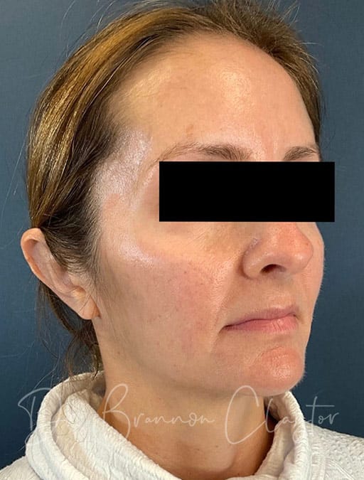 otoplasty-01b-after-cnclaytor