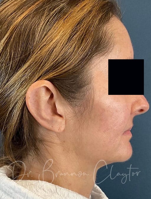 otoplasty-01c-after-cnclaytor