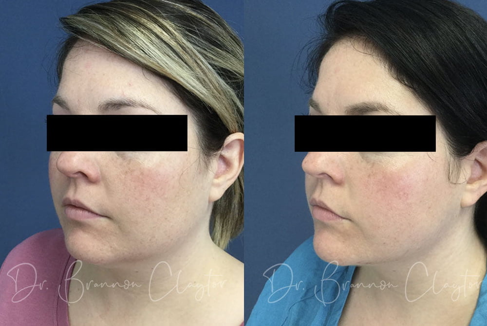 Patient before (left) and after (right) MyEllevate neck lift