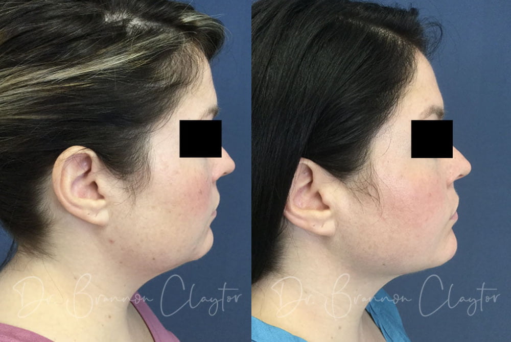 Patient before (left) and after (right) MyEllevate neck lift