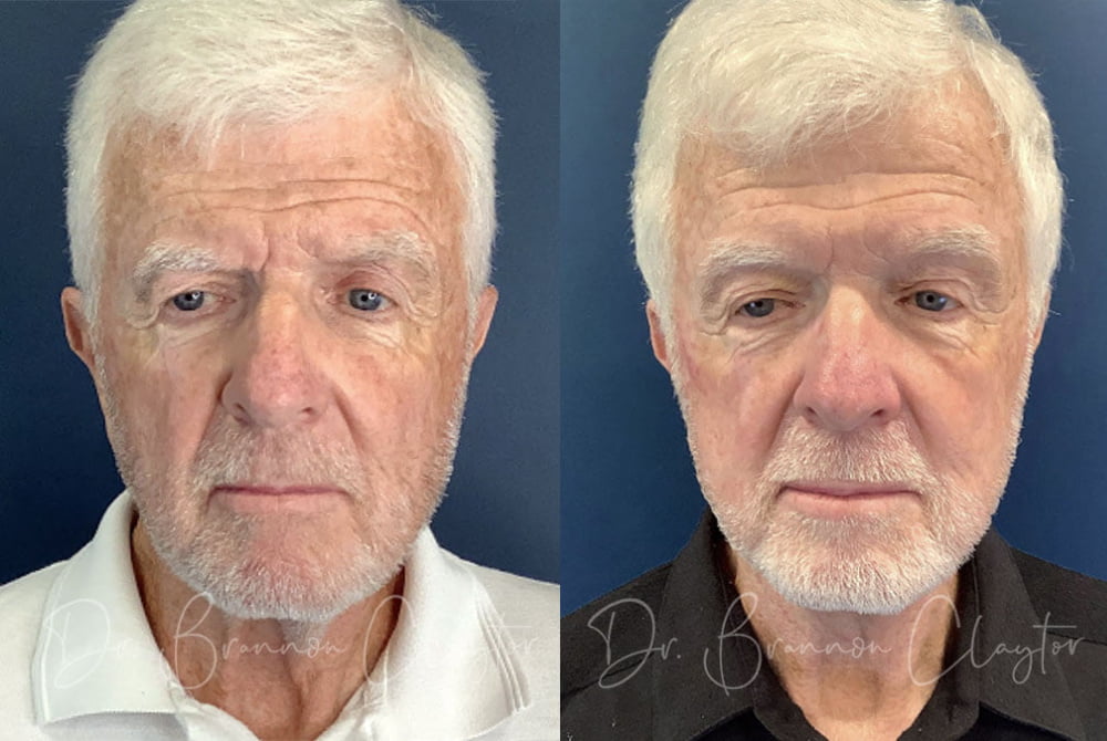 Male Patient before (left) and 6 weeks after (right) MyEllevate neck lift