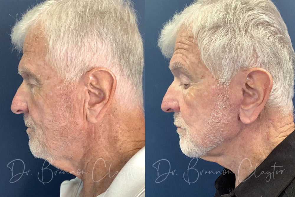 Male Patient before (left) and 6 weeks after (right) MyEllevate neck lift. 