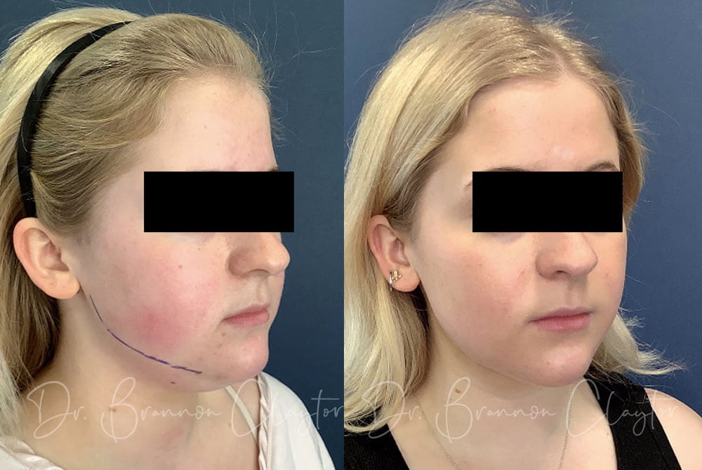 Patient before (left) and 1 month after (right) MyEllevate neck lift with liposuction