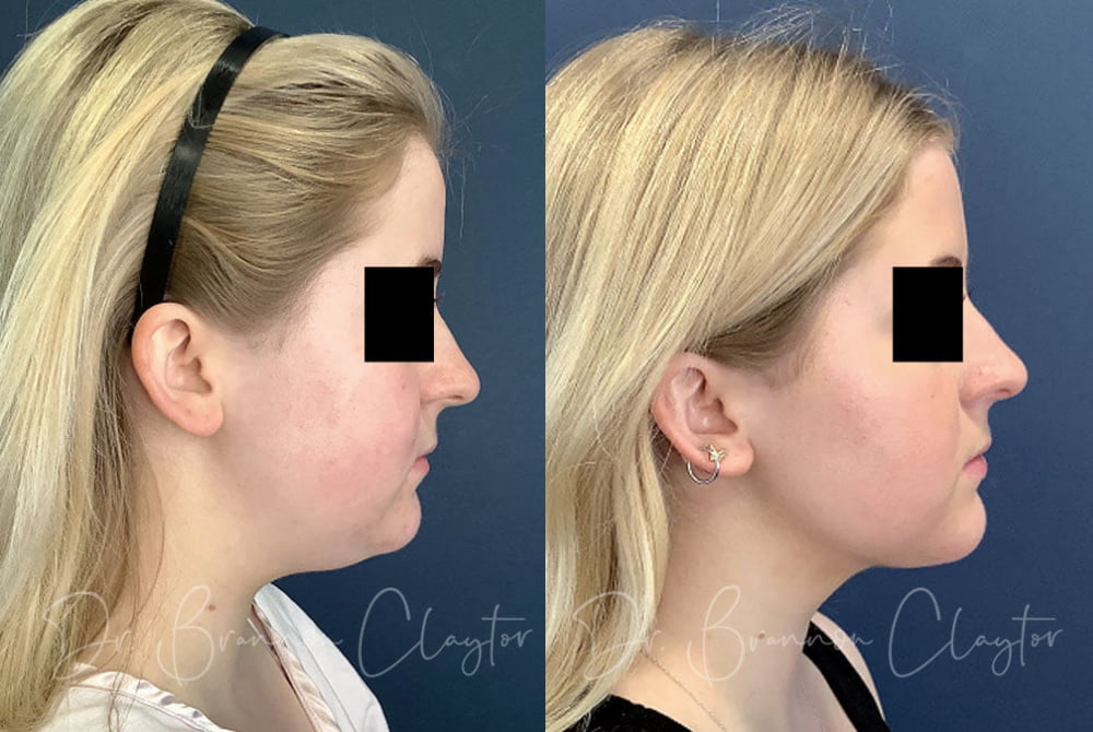 Patient before (left) and 1 month after (right) MyEllevate neck lift. 