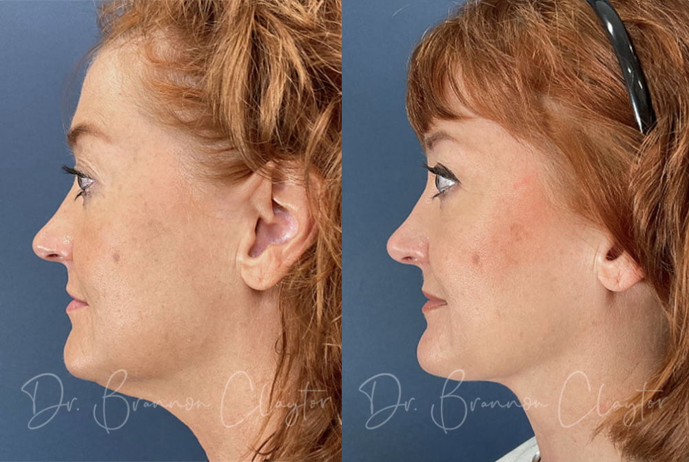 Patient before (left) and 4 months after (right) MyEllevate neck lift