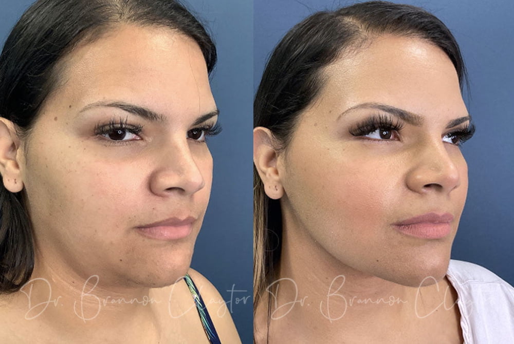  Patient before (left) and after (right) MyEllevate neck lift with SmartLipo