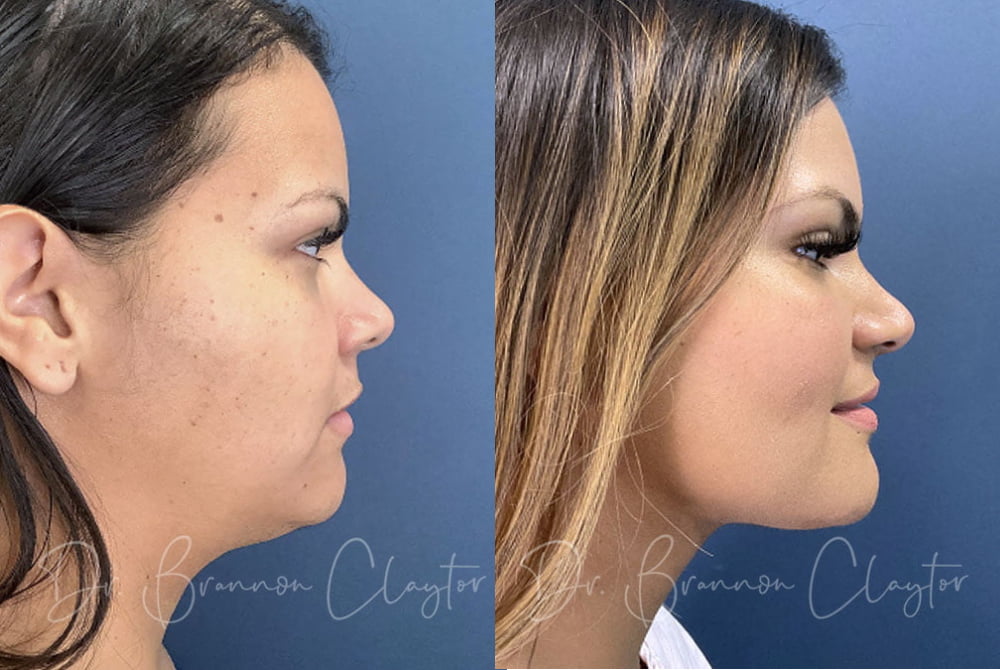 Patient before (left) and after (right) MyEllevate neck lift with SmartLipo