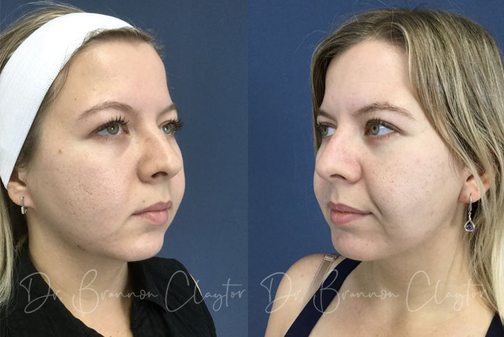  Patient before (left) and after (right) MyEllevate neck lift