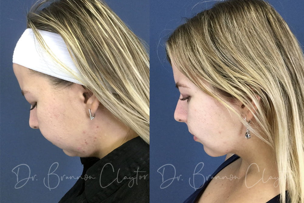 Patient before (left) and after (right) MyEllevate neck lift.