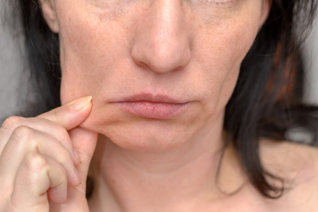 Woman with Ozempic face after rapid weight loss with semaglutide injections resulted in excess, sagging skin