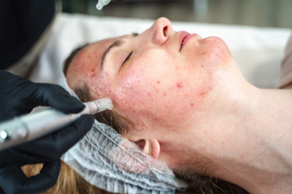 Woman getting a microneedling treatment