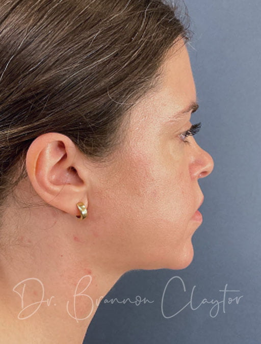Neck Liposuction