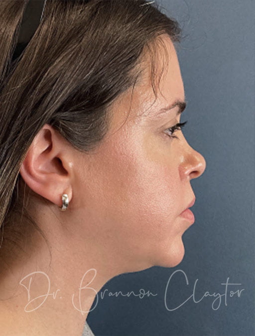 Neck Liposuction