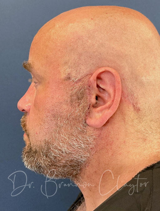 Facelift and Neck Lift