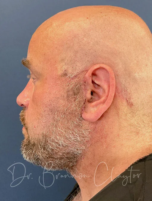 Facelift and Neck Lift