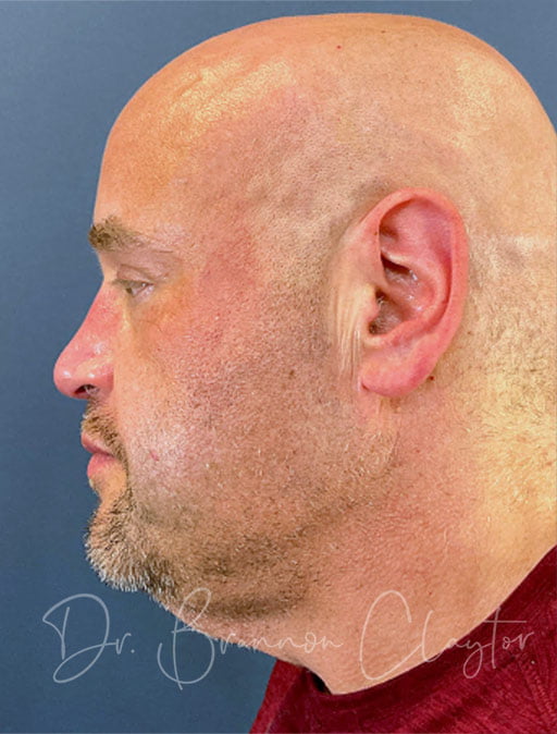 Facelift and Neck Lift