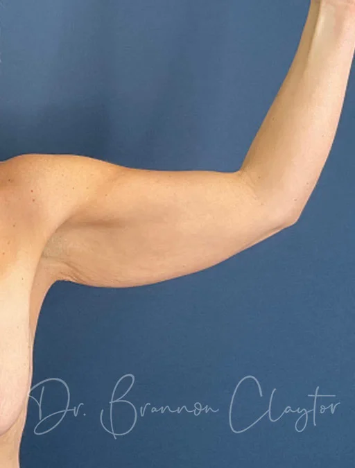 arm-lift-49954a-left-before
