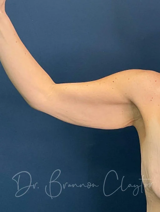 arm-lift-49954a-right-before