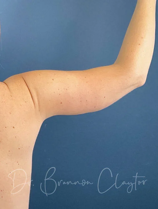 arm-lift-49954d-right-after