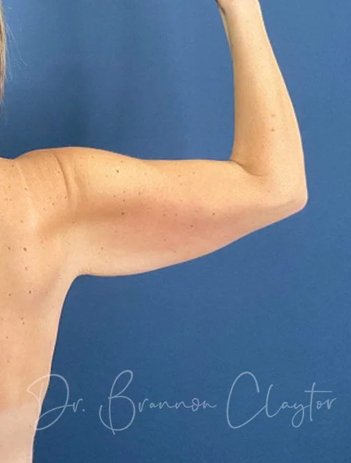 arm-lift-49954d-right-before