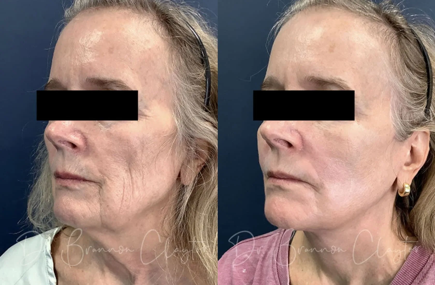Real patient of Philadelphia facelift surgeon Dr. R. Brannon Claytor