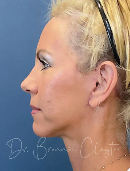 Deep Plane Facelift and Neck Lift