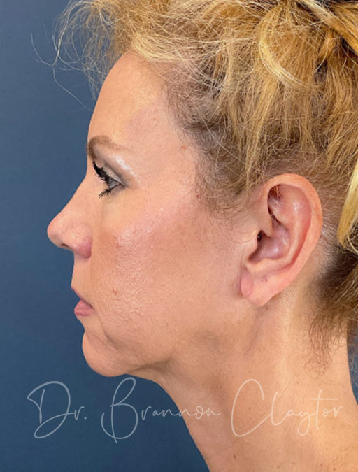 Deep Plane Facelift and Neck Lift
