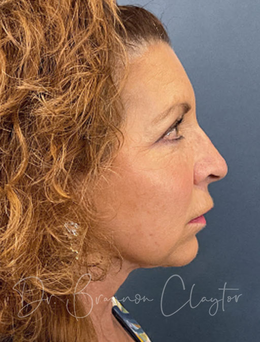 Facelift and Neck Lift Revision