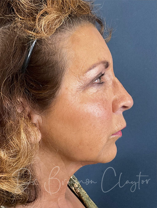 Facelift and Neck Lift Revision