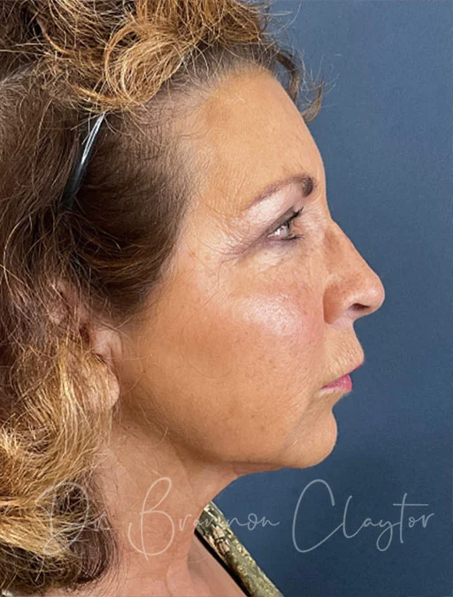 Facelift and Neck Lift Revision