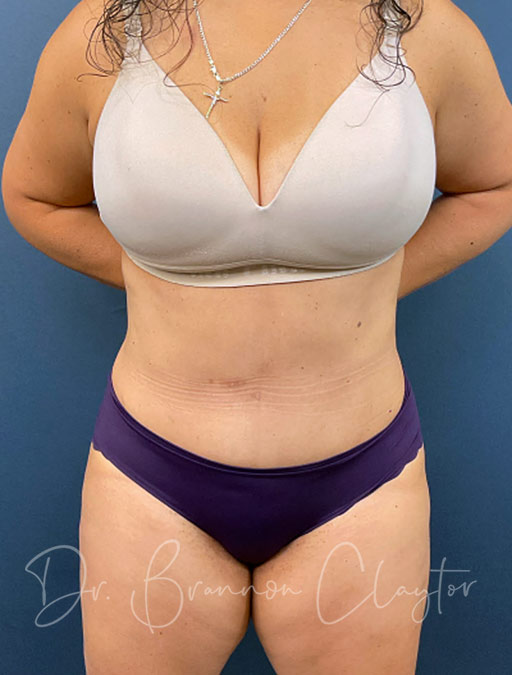 Drainless Tummy Tuck with 360 Liposuction