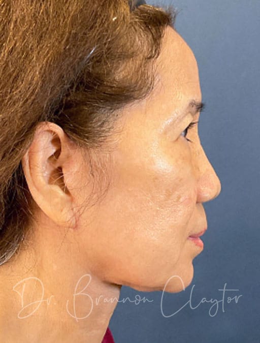 Deep Plane Facelift & Neck Lift