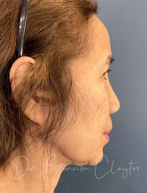 Deep Plane Facelift & Neck Lift