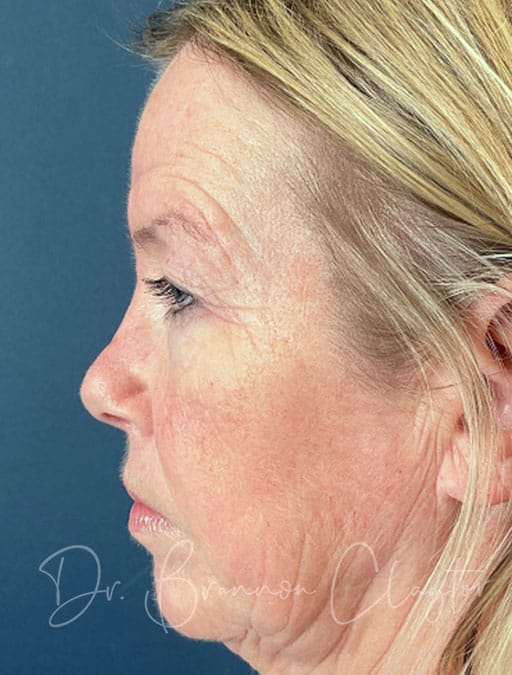 Eyelid Surgery