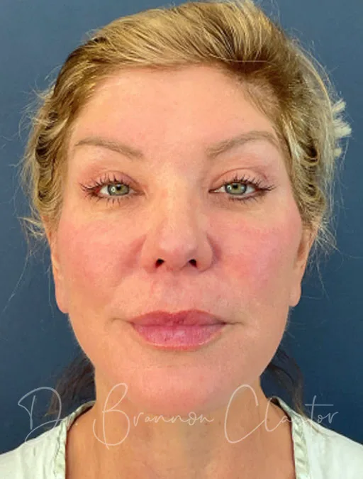 facelift-deep-plane-52994-2a-after-claytor