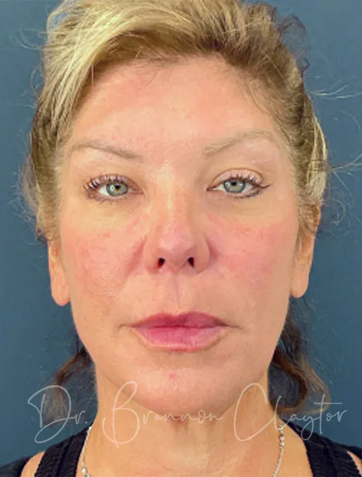 facelift-deep-plane-52994-2a-before-claytor