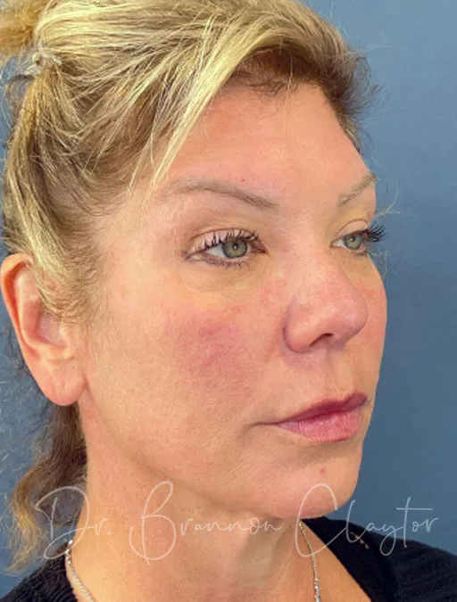 facelift-deep-plane-52994-2b-before-claytor