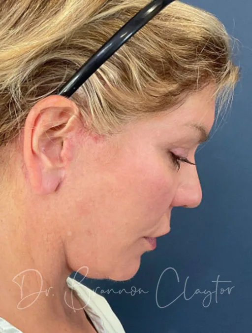 facelift-deep-plane-52994-2d-after-claytor
