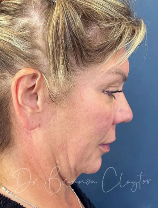 facelift-deep-plane-52994-2d-before-claytor