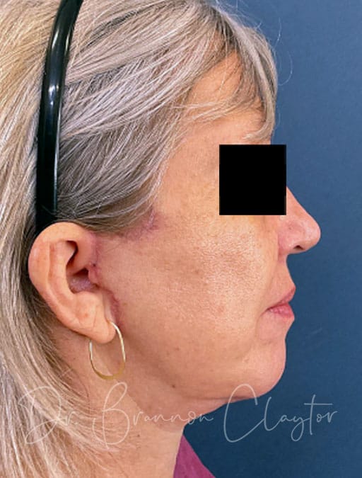 Lower Facelift & Neck Lift