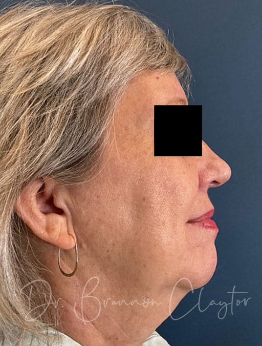 Lower Facelift & Neck Lift