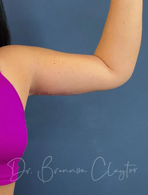 arm-lift-49951a-left-after-claytor