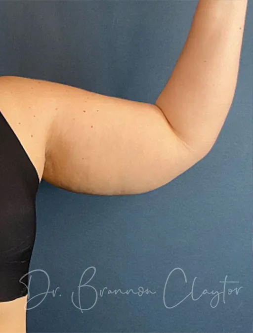 arm-lift-49951a-left-before-claytor